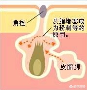 直播欧洲杯怎么去黑头泥膜: